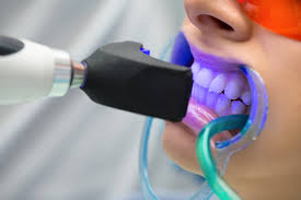 Tooth whitening in Mayur Vihar by A&M dental station