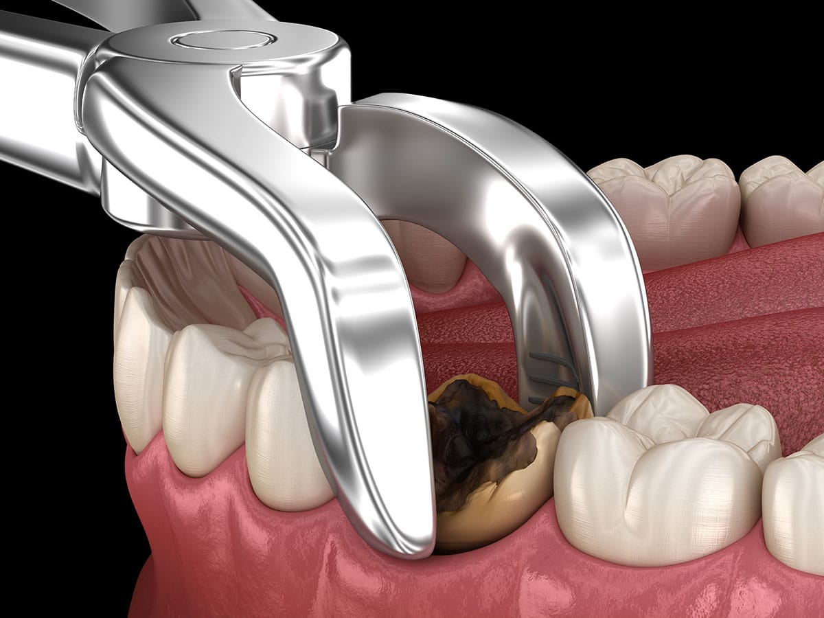 Wisdom tooth removal in Mayur Vihar by A&M dental station
