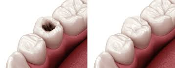Tooth fillings in Mayur Vihar by A&M dental station