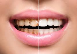 scaling-polishing in Mayur Vihar by A&M dental station